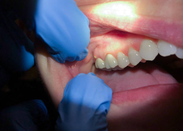 Best Emergency Broken Tooth Repair in Hopkins, MN
